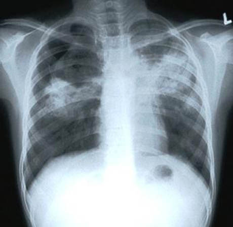 tuberculosis x ray. tuberculosis-xray