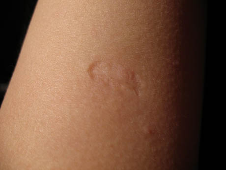 smallpox vaccination scar